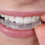 Why Should I Go With Invisible Braces?