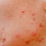 Ayurvedic approaches to treat skin allergies